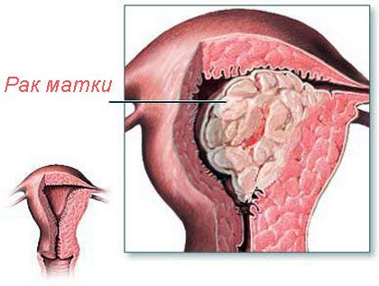endometrium rák menopauza)